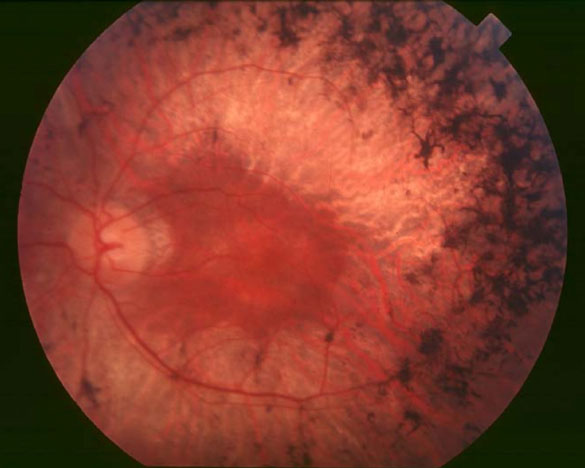 Interior of an eye affected by retinitis pigmentosa.